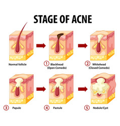 Stages Skin Acne Anatomy