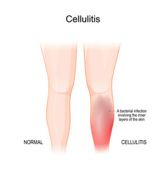 Skin Cellulitis Healthy Leg And Leg