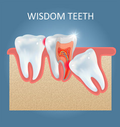 Wisdom Teeth Problems Poster Design