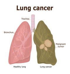 Lung Cancer