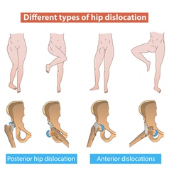 Different Types Of Hip Dislocation