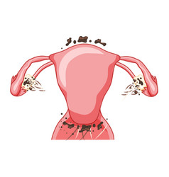 Endometriosis 3 Stage Female Reproductive System