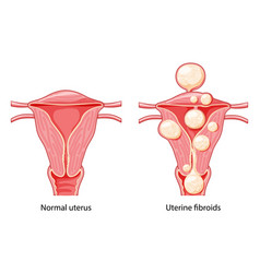 Set Of Uterine Fibroids Female Leiomyomas