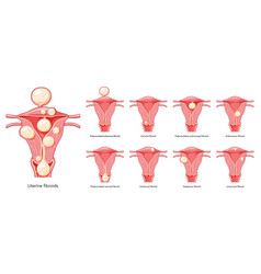 Set Of Uterine Fibroids Female Leiomyomas