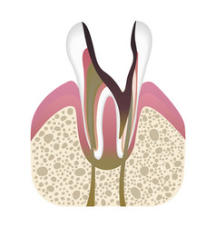 Stage Of Caries Development Tooth Structure