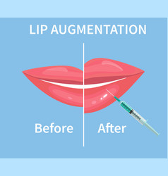 Lip Augmentation Before And After Filler