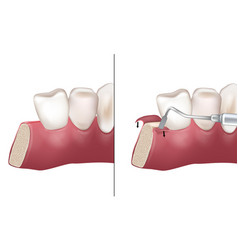 Mid-crestal Incision Used During Implant Bed