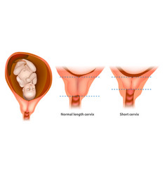 Normal Length And Short Cervix