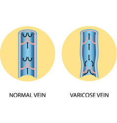 A Comparison Of Normal Vein With Varicose Vein