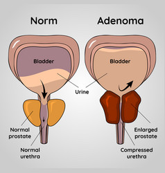 Normal Bladder And Bph Problem Prostate Adenoma