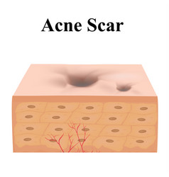 Atrophic Scars Acne Scar The Anatomical