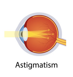 Astigmatism And Vision Disorders