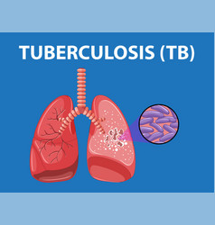 Human Lung Anatomy With Tuberculosis Infographic