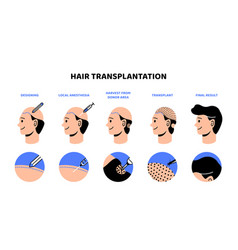 Hair Transplantation Process Infographic