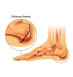 Calcaneus Fracture