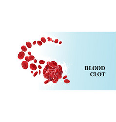 Blood Clot Thrombus Medical Poster