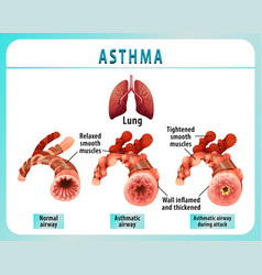 Bronchial Asthma Diagram With Normal Airway