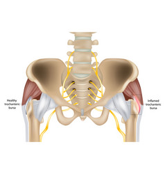 Hip Trochanteric Bursitis Is Inflammation