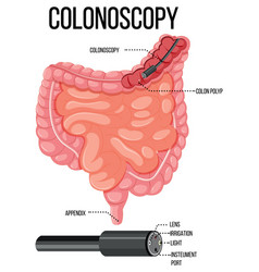 Diagram Showing Colonoscopy In Human