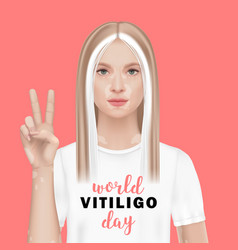 World Vitiligo Day A Woman