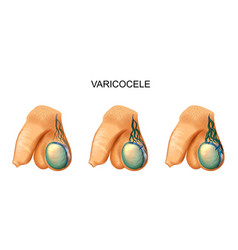 Varicocele On Testicle