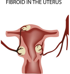 Female Organ Tumor Disease Fibroid