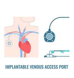 Implantable Venous Access Port On Male Body