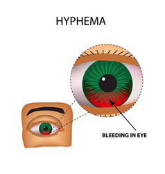 Hyphema Anterior Eye Hemorrhage Structure Eye