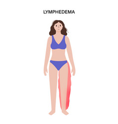 Lymphedema Leg Swelling