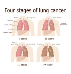 Four Stages Of Lung Cancer