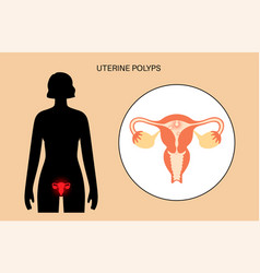 Uterus Polyps Disease