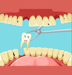 Tooth Extraction Inside Human Mouth