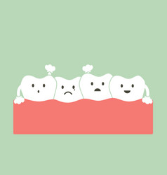 Crowding Teeth Or Malocclusion