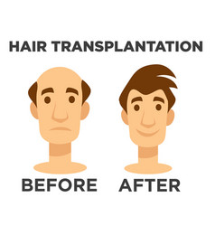 Hair Transplantation Before And After Effect Bald