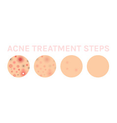 Acne Treatment Steps Whitening Of Human Skin