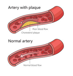 Arteriosclerotic Vascular Disease Diagram Science