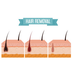 Layers Skin Structure With Hair Removal Icons