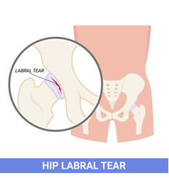 Labral Of Hip That Tear And Injury The Disorder