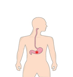 Peptic Ulcer