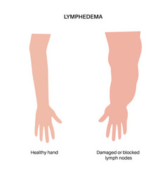 Lymphedema Of Arm