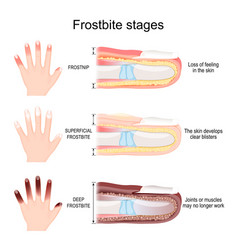 Frostbite Stages Of Fingers