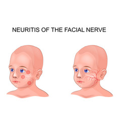 Facial Nerve Neuritis In A Child