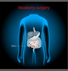 Ileostomy Stoma Surgical Opening Of Small