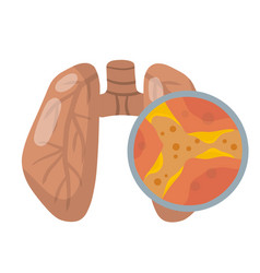 Lung Disease Blockage Of Canal