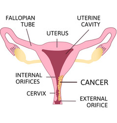 Cervical Cancer Carcinoma Cervix Malignant