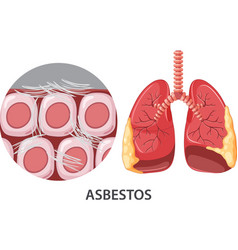 Asbestosis On Human Lungs