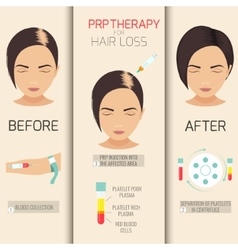 Prp Therapy For Hair Loss