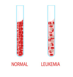 Leukemia