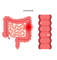 Colon Polyps Inflammation