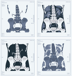 Set X-ray Of Human Abdomen With Pelvic Bone